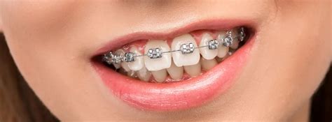 brackets metalicos ventajas|bracket dental precio.